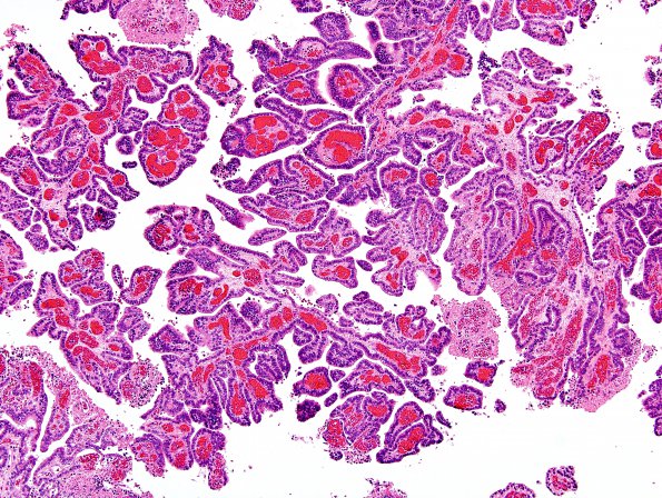 11A2 Choroid Plexus Papilloma with anaplasia-CA (Case 11) H&E 6