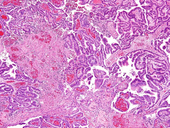 11A4 Choroid Plexus Papilloma with anaplasia-CA (Case 11) H&E 9