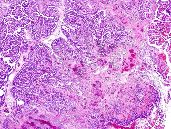 11A6 Choroid Plexus Papilloma with anaplasia-CA (Case 11) H&E 12