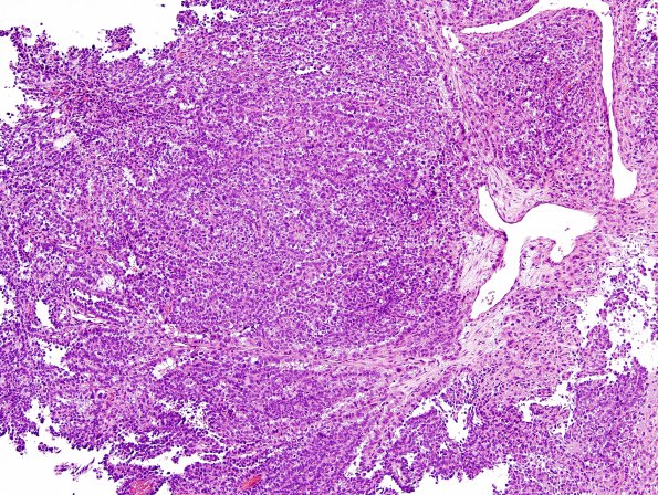 11A7 Choroid Plexus Papilloma with anaplasia-CA (Case 11) H&E 16