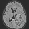 12A1 Choroid plexus papilloma, atypical (Case 12) FLAIR - Copy