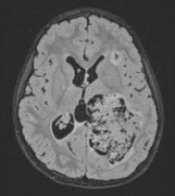 12A1 Choroid plexus papilloma, atypical (Case 12) FLAIR - Copy