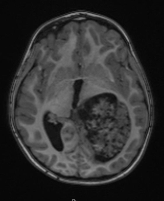 12A2 Choroid plexus papilloma, atypical (Case 12) T1 MPRAGE - Copy