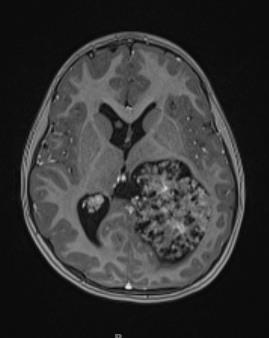 12A3 Choroid plexus papilloma, atypical (Case 12) T1 MPRAGE W contrast - Copy