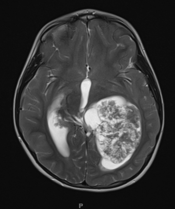 12A4 Choroid plexus papilloma, atypical (Case 12) T2 2 - Copy