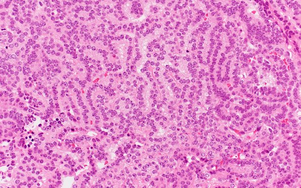 12B1 Choroid plexus papilloma, atypical (Case 12) H&E 1