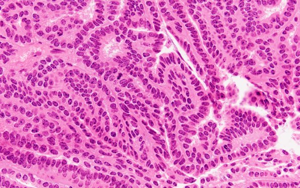 12B2 Choroid plexus papilloma, atypical (Case 12) H&E 6