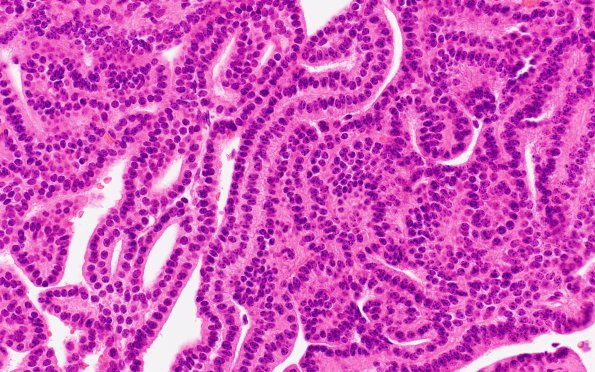 12B3 Choroid plexus papilloma, atypical (Case 12) H&E 14