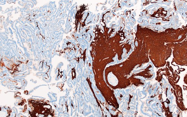 12D1 Choroid plexus papilloma, atypical (Case 12) GFAP 2