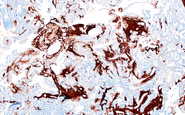 12D2 Choroid plexus papilloma, atypical (Case 12) GFAP 8