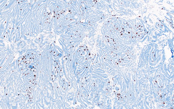 12F1 Choroid plexus papilloma, atypical (Case 12) Ki67 1