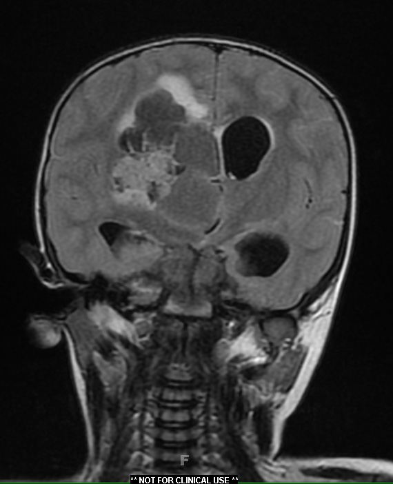 13A1 Choroid Plexus Papilloma, atypical WHO II (Case 13) T2 FLAIR - Copy