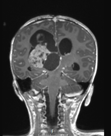 13A2 Choroid Plexus Papilloma, atypical WHO II (NP18-978) T1W - Copy