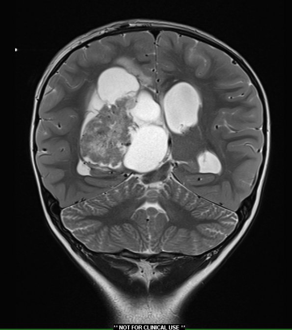 13A3 Choroid Plexus Papilloma, atypical WHO II (Case 13) T2 with contrast 2 - Copy