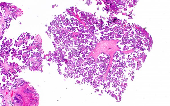 13B1 Choroid Plexus Papilloma, atypical (Case 13) H&E 1