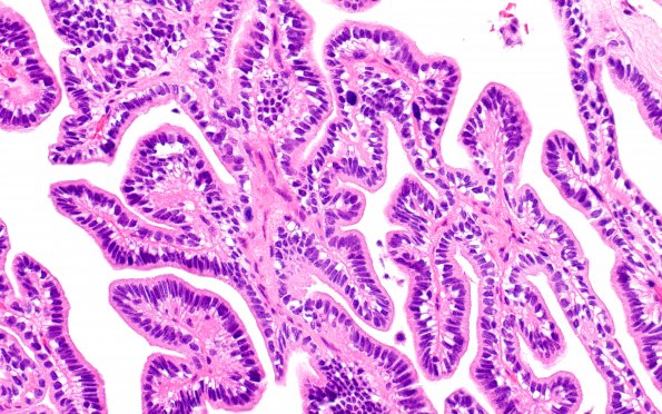 13B2 Choroid Plexus Papilloma, atypical (Case 13) H&E 4