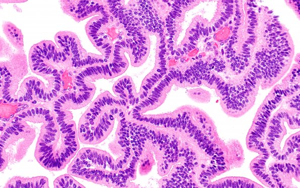 13B3 Choroid Plexus Papilloma, atypical (Case 13) H&E 6