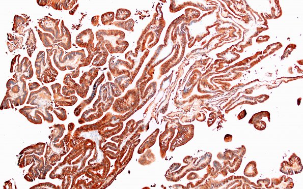 13C2 Choroid Plexus Papilloma, atypical (Case 13) S100 1