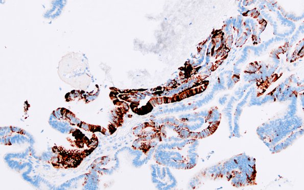 13D1 Choroid Plexus Papilloma, atypical (Case 13) GFAP 2