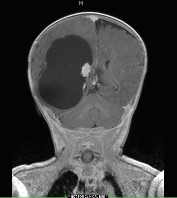 14A1 Choroid Plexus Papilloma, atypical WHO II (Case 14) T1W 1 - Copy