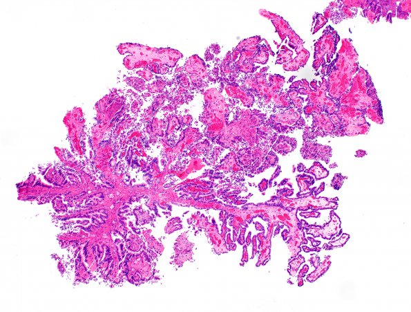 14B1 Choroid Plexus Papilloma, atypical (Case 14) H&E 2