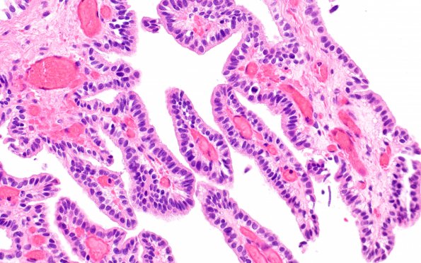 14B2 Choroid Plexus Papilloma, atypical (Case 14) H&E 3