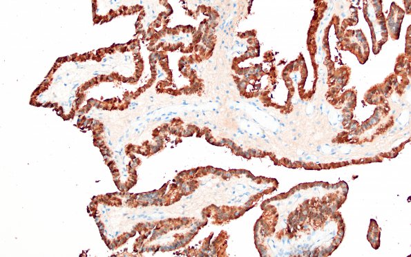 14C Choroid Plexus Papilloma, atypical (Case 14) S100