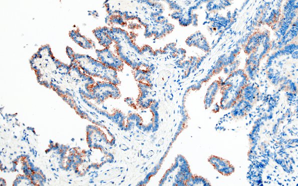 14D1 Choroid Plexus Papilloma, atypical (Case 14) P53 2