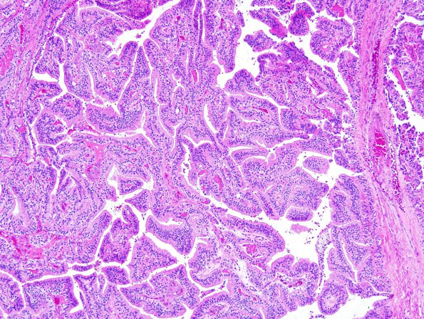 15A1 Choroid Plexus Papilloma, Atypical (Case 15) 1.jpg