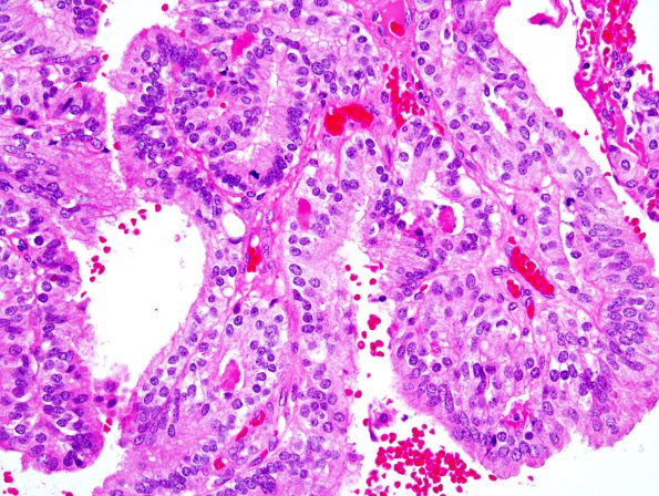 15A2 Choroid Plexus Papilloma, Atypical (Case 15) 2.jpg