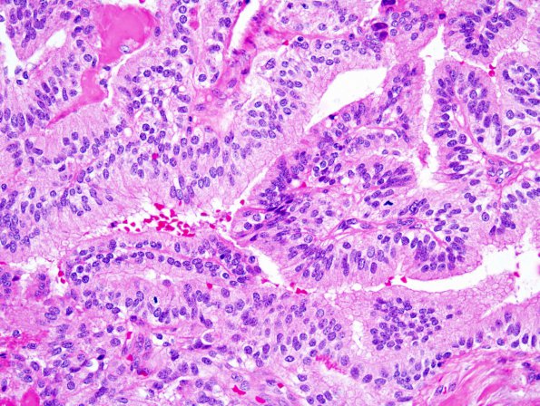 15A3 Choroid Plexus Papilloma, Atypical (Case 15) 4.jpg