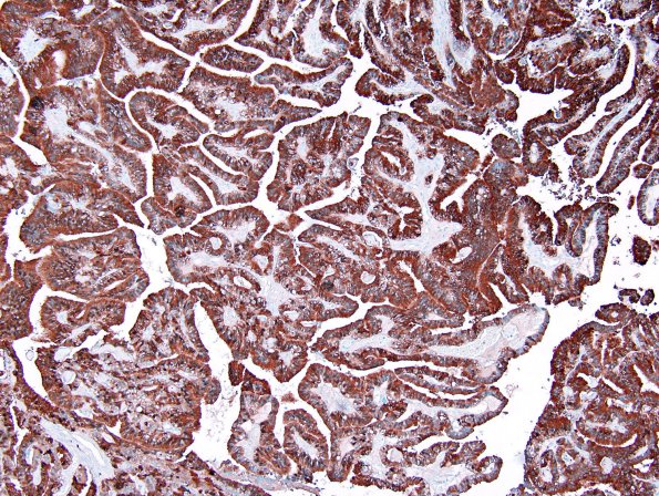 15B1 Choroid Plexus Papilloma, Atypical (Case 15) S-100 1.jpg