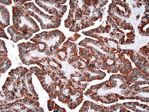 15B2 Choroid Plexus Papilloma, Atypical (Case 15) S-100 2.jpg