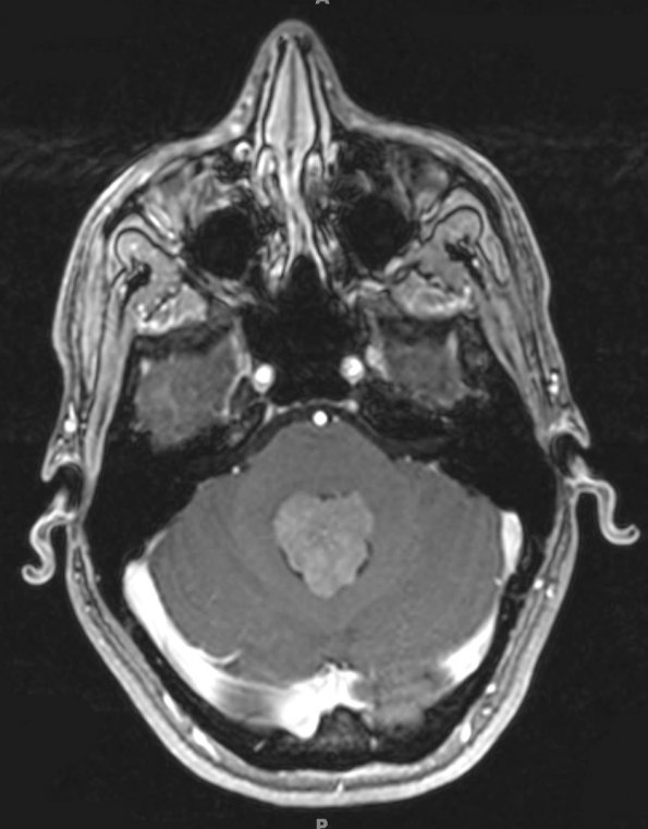 16A1 Choroid plexus papilloma, atypical (Case 16) T1 Postcontrast 3 - Copy