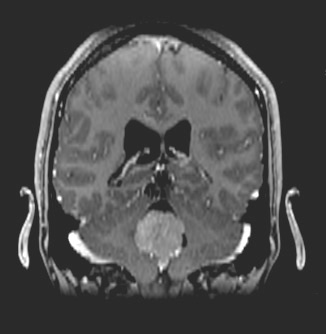 16A3 Choroid plexus papilloma, atypical (Case 16)-MRI- T1 post contrast-2 - Copy