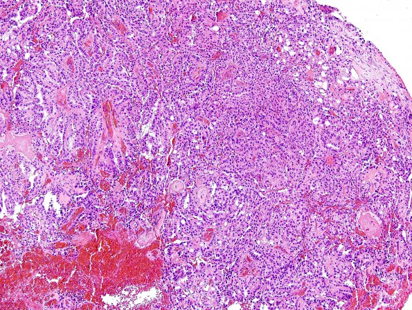 16B2 Choroid plexus papilloma, atypical (Case 16) H&E 2