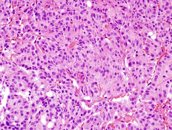 16B3 Choroid plexus papilloma, atypical (Case 16) H&E 4