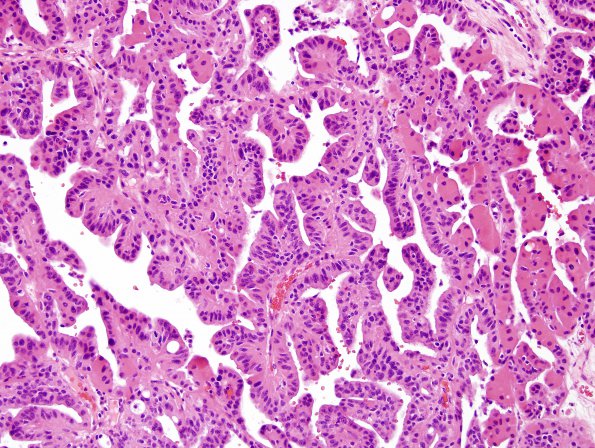 16B4 Choroid plexus papilloma, atypical (Case 16) H&E 8