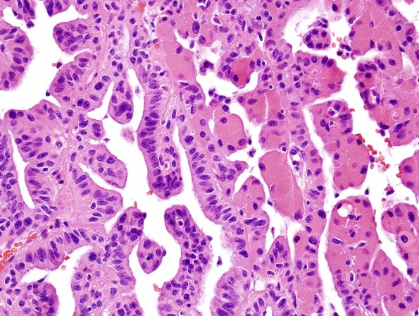 16B5 Choroid plexus papilloma, atypical (Case 16) H&E 9