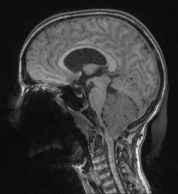 17A1 Choroid Plexus Papilloma, atypical (Case 17) T1 1 - Copy