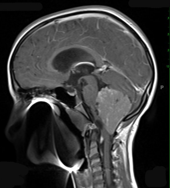 17A2 Choroid Plexus Papilloma, atypical (Case 17) T1 W 3 - Copy