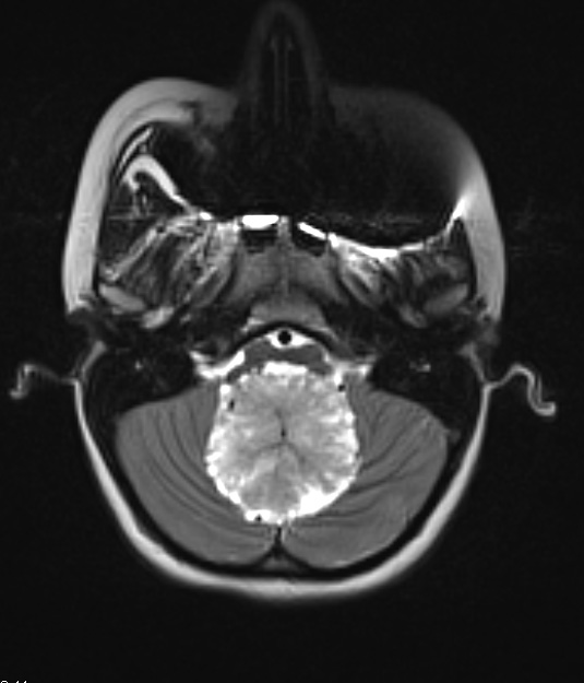 17A3 Choroid Plexus Papilloma, atypical (Case 17) T2 3 - Copy