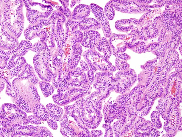 17B2 Choroid Plexus Papilloma, atypical (Case 17) H&E 10