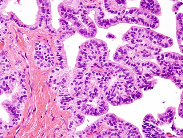 17B3 Choroid Plexus Papilloma, atypical (Case 17) H&E 2