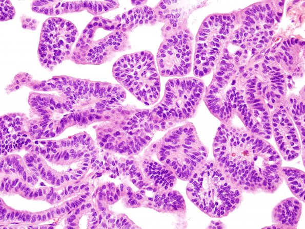 17B4 Choroid Plexus Papilloma, atypical (Case 17) H&E 6