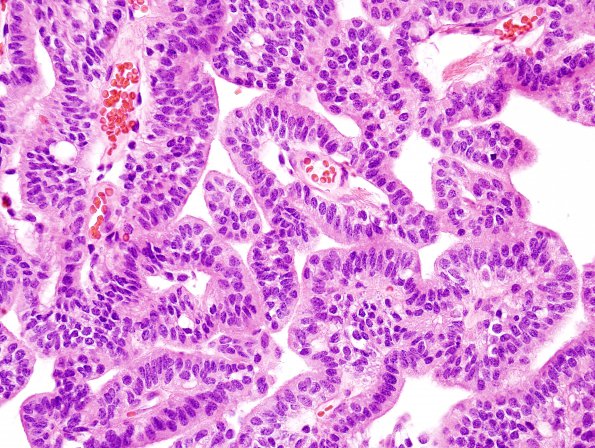 17B5 Choroid Plexus Papilloma, atypical (Case 17) H&E 9