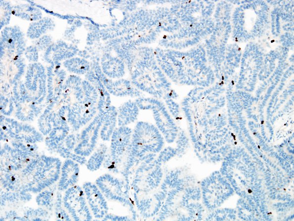 17C1 Choroid Plexus Papilloma, atypical (Case 17) Ki67 4