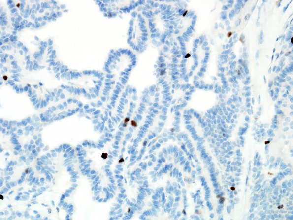 17C2 Choroid Plexus Papilloma, atypical (Case 17) Ki67 2