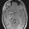 18A1 Choroid Plexus Papilloma (Case 18) T1 W 1 - Copy