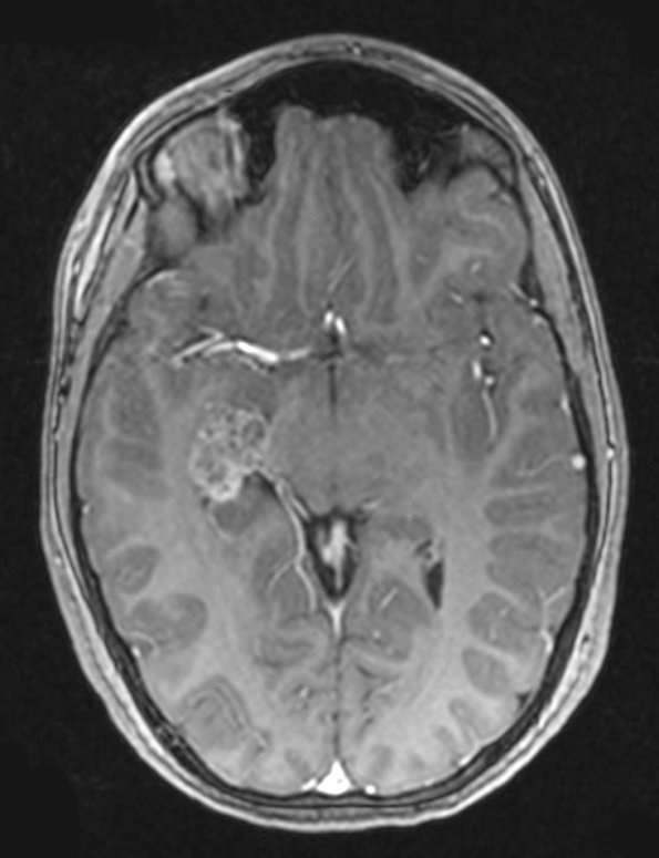 18A1 Choroid Plexus Papilloma (Case 18) T1 W 1 - Copy